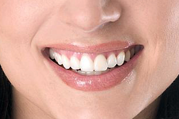 Close up of client's smile.