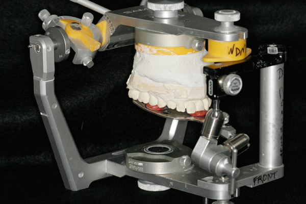 study models mounted by means of a face bow and CR bite registration on a Sam III articulator.