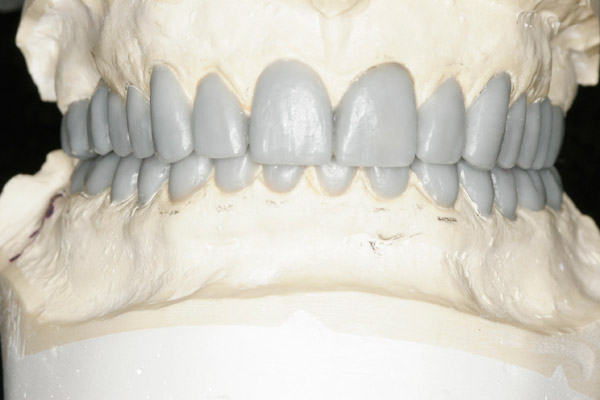 Dynamic occlusal and aesthetic diagnostic wax up.